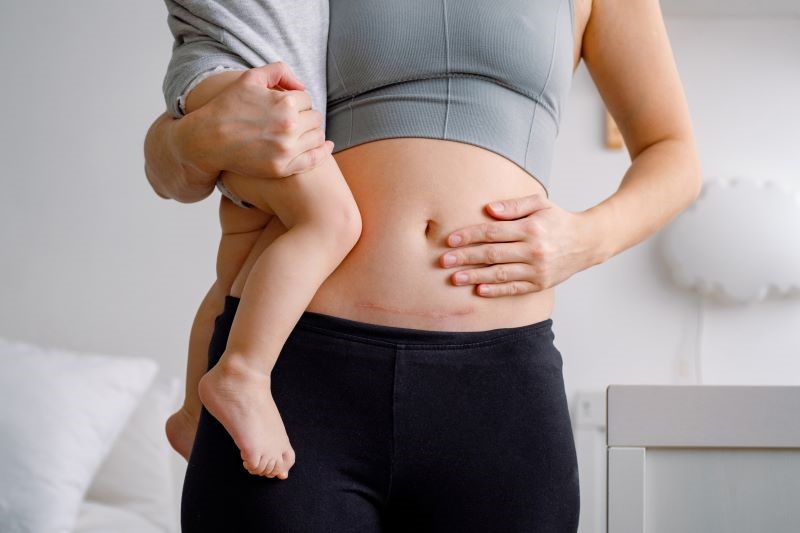 Case Study - Postpartum Hydrogel Dressing C-session Hydrogel Dressing